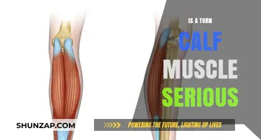 Understanding the Severity of a Torn Calf Muscle: A Comprehensive Guide