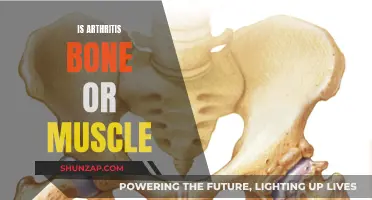 Arthritis: Bone or Muscle? Understanding the Root Cause