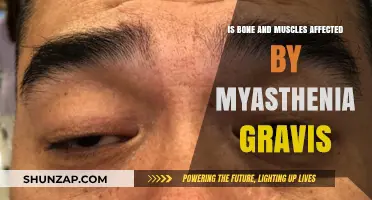 Exploring Myasthenia Gravis: Impact on Bones and Muscles