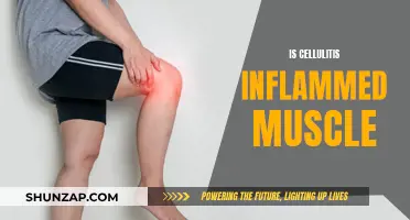 Muscle Inflammation: Understanding Cellulitis and its Impact