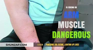 Is Arm Muscle Edema Dangerous? Understanding Risks and Symptoms
