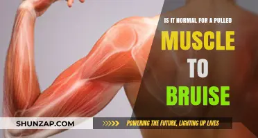 Is Bruising Common with Pulled Muscles? Understanding the Symptoms