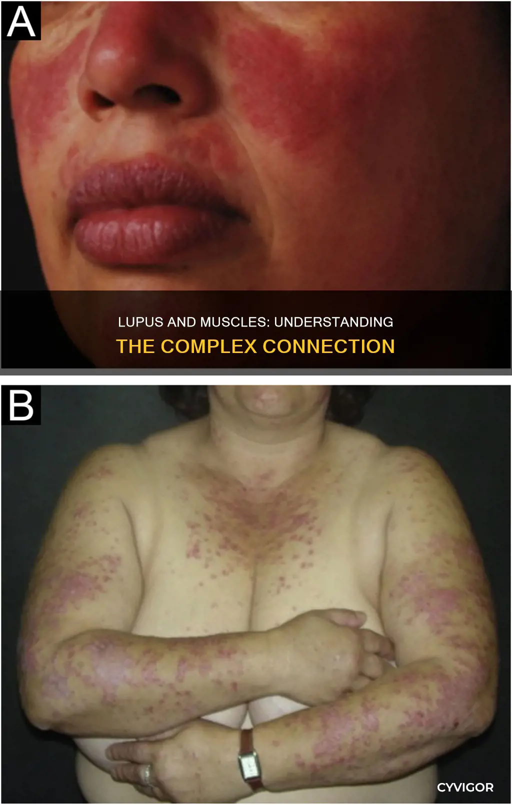is lupus a muscle disease
