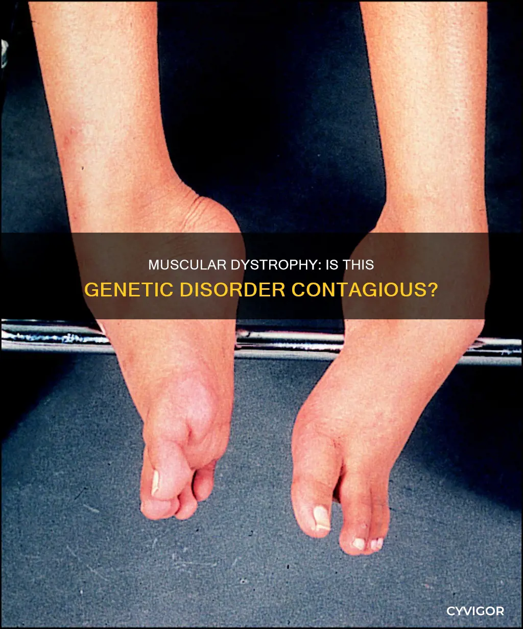 is musclar dystophy disease contagious