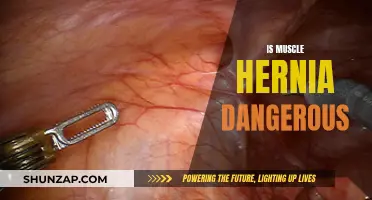 Muscle Hernia: Is It a Dangerous Condition?