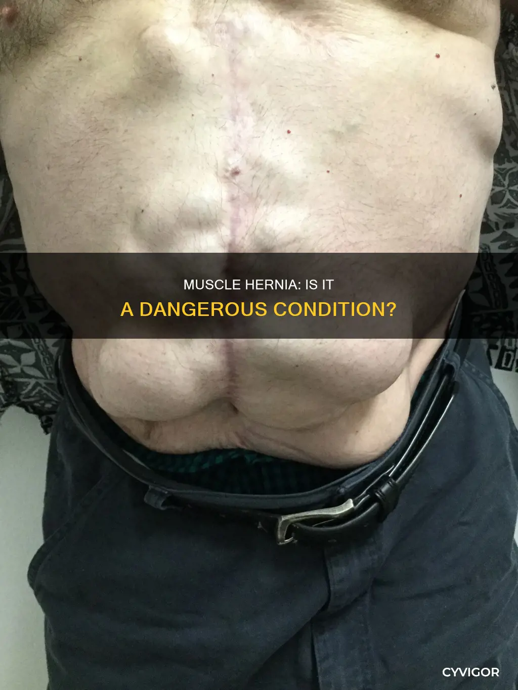 is muscle hernia dangerous