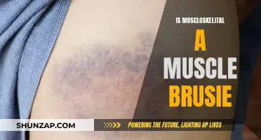 Muscle Bruises: Are They Musculoskeletal Injuries?