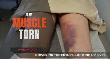 Muscle Tears: Signs, Symptoms, and Treatment Options
