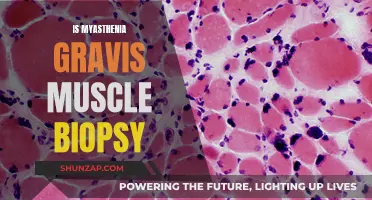 Myasthenia Gravis: Muscle Biopsy Diagnosis and Treatment Options
