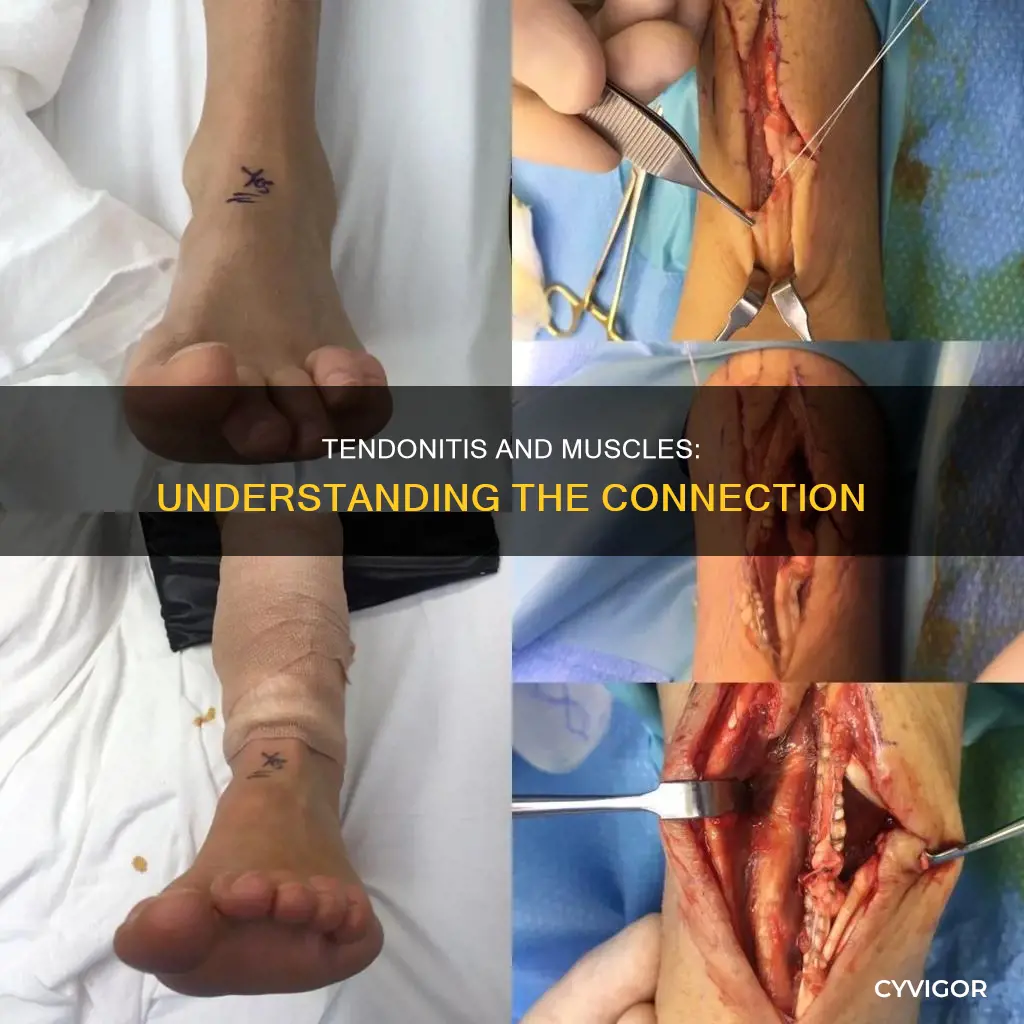 is tendonitis a muscle disease