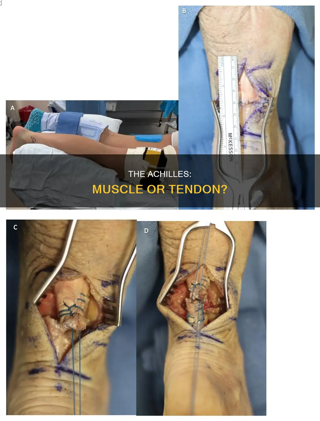 is the achilles a muscle