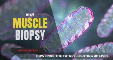 Muscle Biopsy: Unraveling the Mystery of ME/CFS