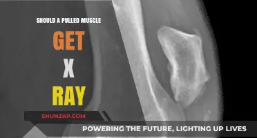 Pulled Muscle or Something Worse? When to Get an X-Ray