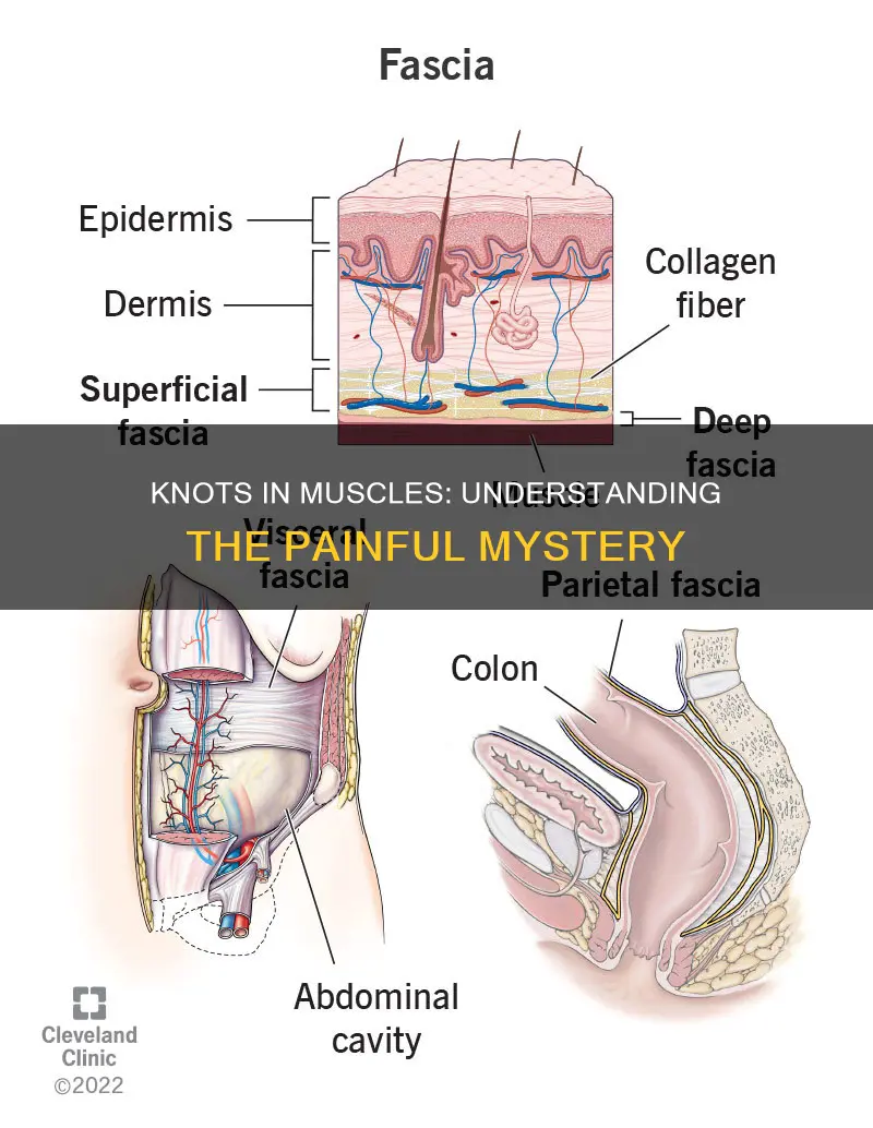 what a knots in muscles
