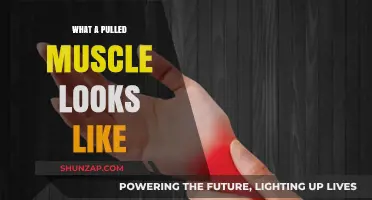 Understanding Pulled Muscles: Visual Signs and Symptoms Explained