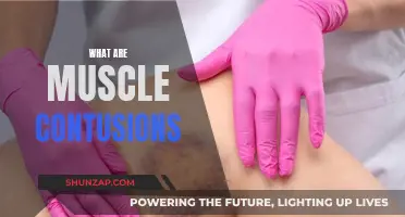 Muscle Contusions: Understanding Bruises and Their Treatment