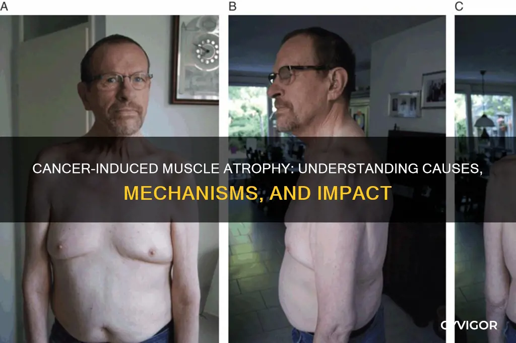 what cancer causes muscle atrophy