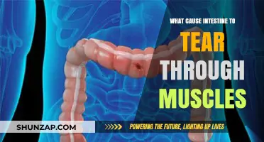 Understanding Intestinal Perforation: Causes of Tearing Through Muscles