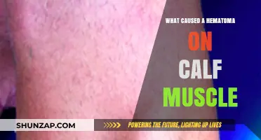Understanding Calf Muscle Hematoma: Causes, Symptoms, and Treatment Options