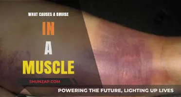 Understanding Muscle Bruises: Causes and Prevention Tips