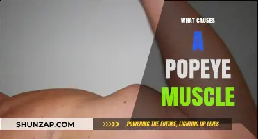 Understanding Popeye Muscle: Causes, Symptoms, and Treatment Options