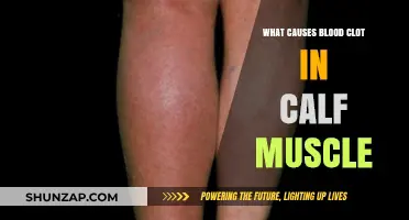 Understanding Calf Muscle Blood Clots: Causes and Risk Factors Explained