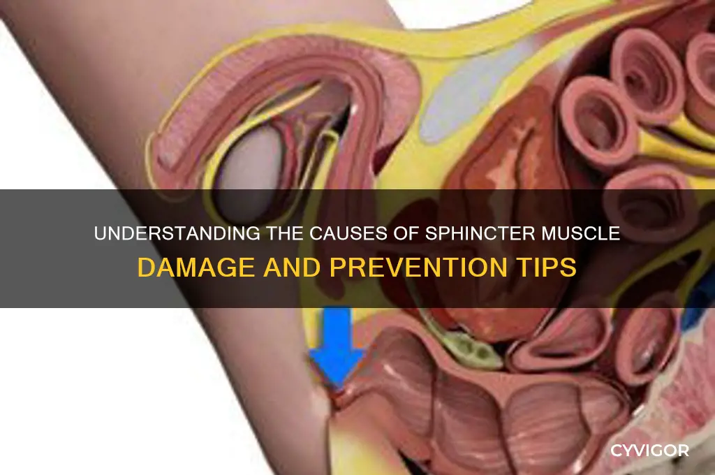what causes damage to sphincter muscle