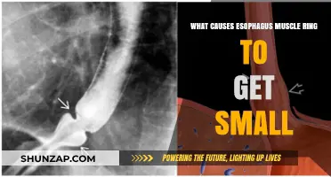 Understanding the Causes of Esophagus Muscle Ring Narrowing