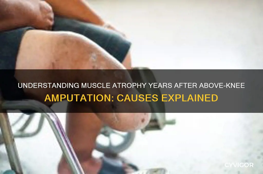 what causes muscle atrophy years after above the knee amputation