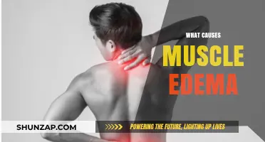 Understanding Muscle Edema: Causes, Symptoms, and Effective Treatment Options
