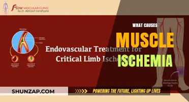 Understanding Muscle Ischemia: Causes, Risk Factors, and Prevention Strategies