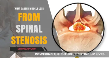 Understanding Muscle Loss: Causes Linked to Spinal Stenosis Explained