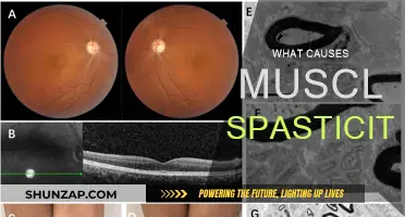 Understanding Muscle Spasticity: Causes and Triggers