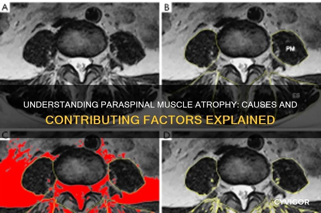 what causes paraspinal muscle atrophy