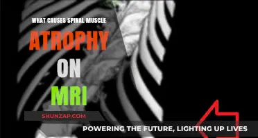 Understanding Spinal Muscle Atrophy: MRI Insights and Causes Explained