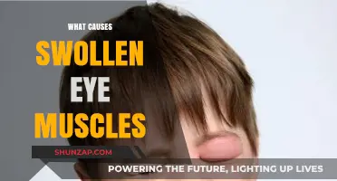 Understanding Swollen Eye Muscles: Causes, Symptoms, and Effective Treatments