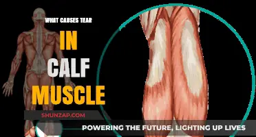 Understanding Calf Muscle Tears: Causes, Risks, and Prevention Strategies