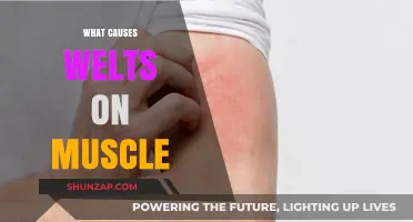 Understanding Welts on Muscles: Causes, Symptoms, and Treatment Options