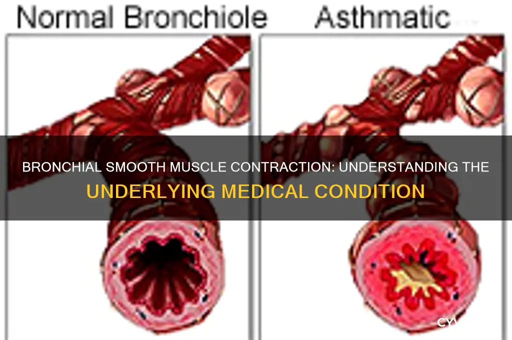 what condition causes contraction of the bronchial smooth muscle