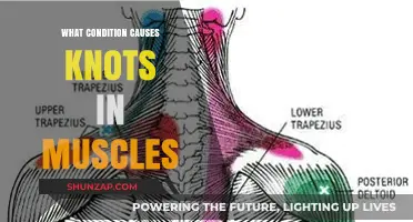 Understanding Muscle Knots: Causes, Symptoms, and Effective Relief Strategies