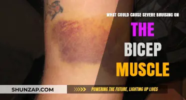 Severe Bicep Bruising: Causes, Symptoms, and Treatment Options Explained