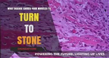 Unraveling Myositis Ossificans: The Rare Condition Turning Muscles to Stone
