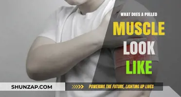 Identifying a Pulled Muscle: Visual Signs and Symptoms Explained