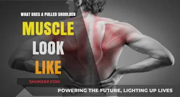 Pulled Shoulder Muscle: Symptoms, Appearance, and Recovery Explained