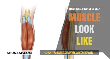 Visual Guide: Identifying a Ruptured Calf Muscle Injury