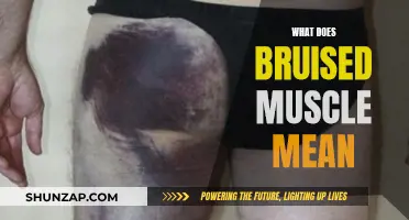 Understanding Bruised Muscles: What Does it Mean?