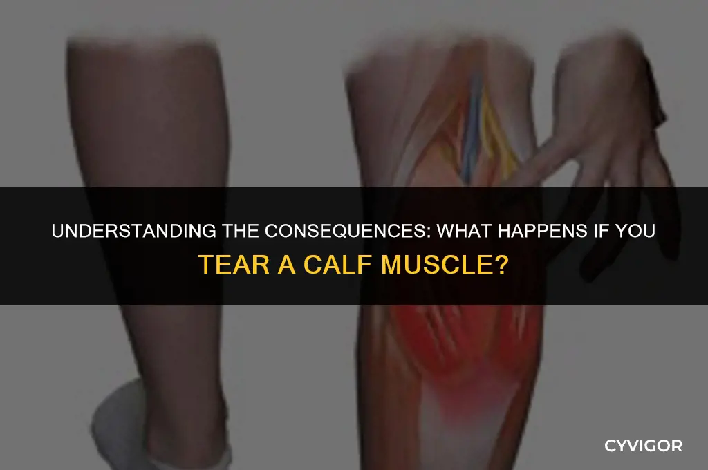 what happens if you tear a calf muscle