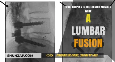 Lumbar Fusion Impact: How Erector Muscles Adapt Post-Surgery