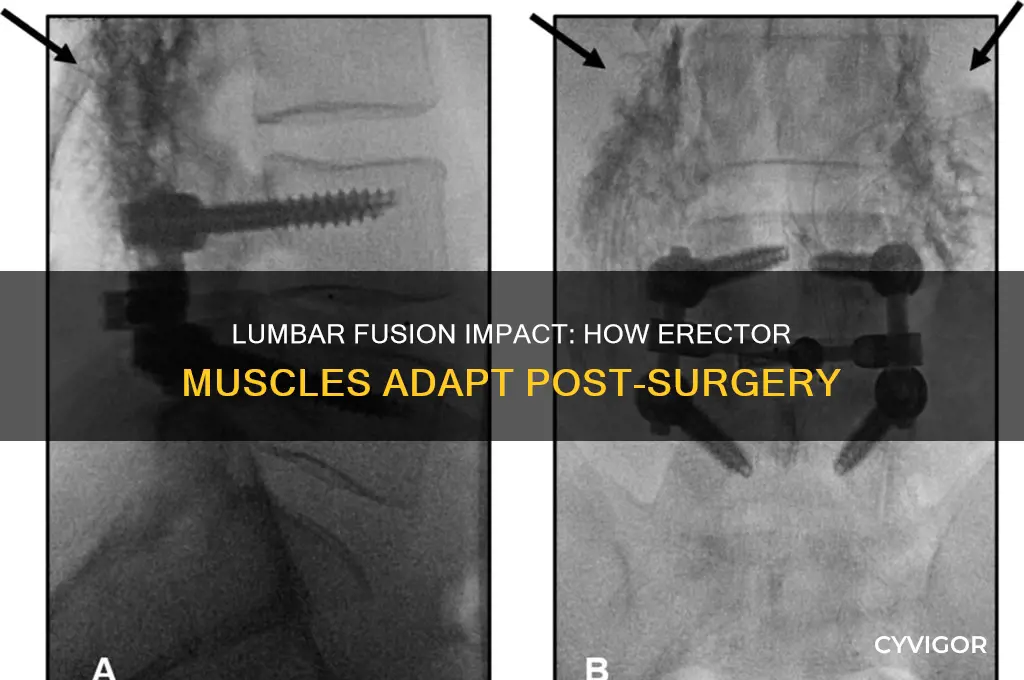 what happens to the erector muscles work a lumbar fusion