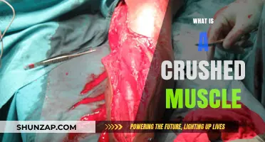 Understanding Crushed Muscle Injuries and Their Impact
